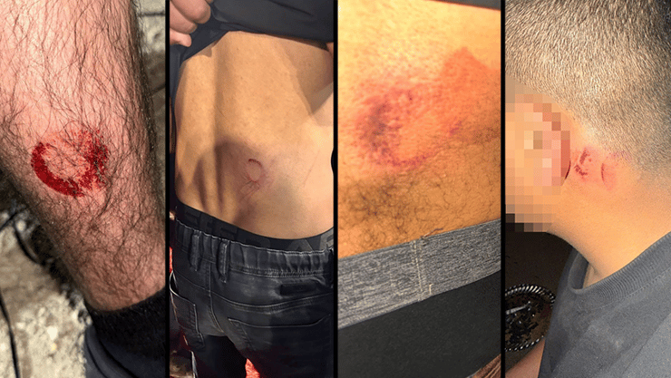 הנפגעים בפשיטה פציעות של המשתתפים בחתונה עליה פשטה המשטרה ביישוב לקיה