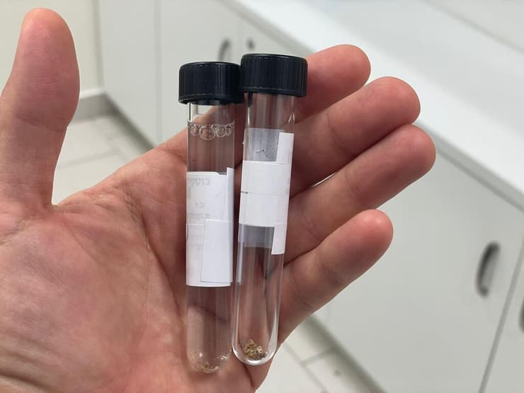 מעידן האבן למהפכה: סוג האבן זוהה ב-82% מהמקרים (צילום: אלבום פרטי) שיטה לאבחון סוג האבן בכליה לאחר ריסוקה בלייזר