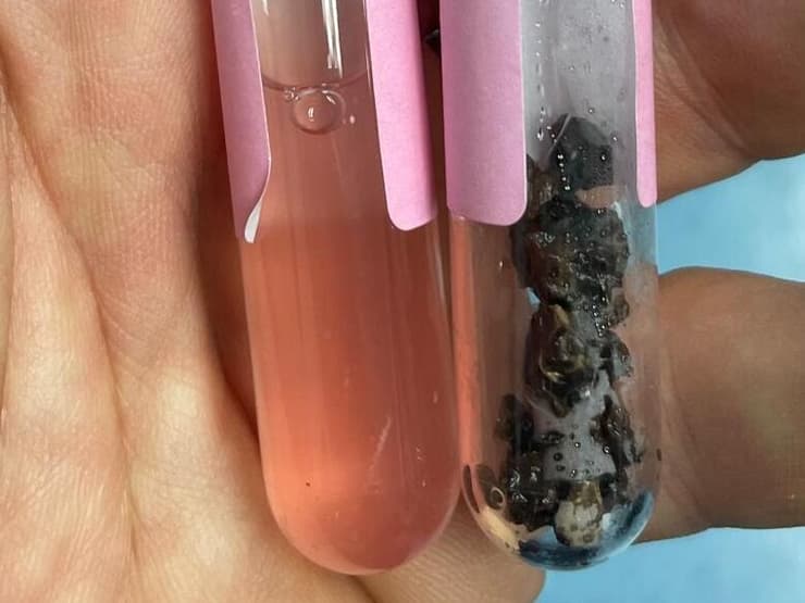 מאבנים מרוסקות לפיצוח ההרכב הכימי (צילום: אלבום פרטי) שיטה לאבחון סוג האבן בכליה לאחר ריסוקה בלייזר