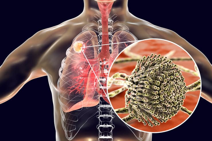 Aspergillus Fumigatus