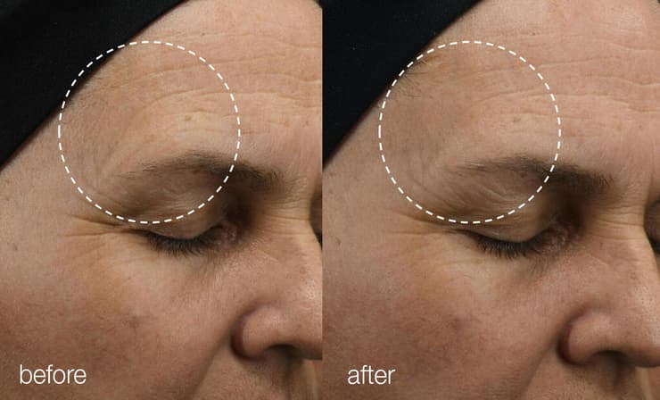 דרמלוג'יקה אקסוזומים 