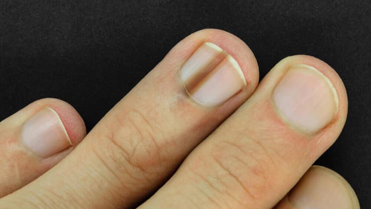 מלנומה תת ציפורנית