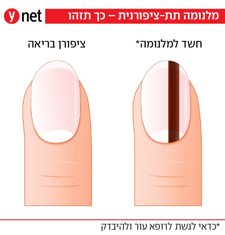 מלנומה תת ציפורנית