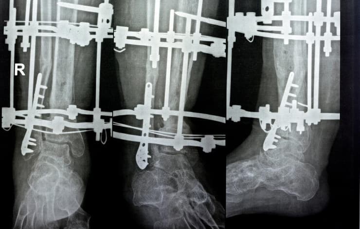 בשיטה המסורתית, הקיבוע מתבצע באמצעות פינים שחודרים את שכבת השריר - הליך שכרוך בכאב רב. ארכיון (צילום: Shutterstock) הארכת גפיים