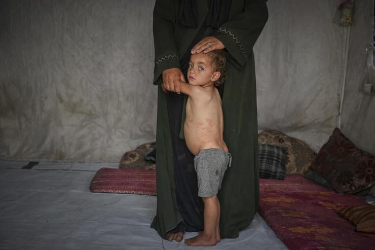 "הילדים שלנו מתים לאט". ילד עזתי בחאן יונס (צילום: AP Photo/Abdel Kareem Hana) חאן יונס