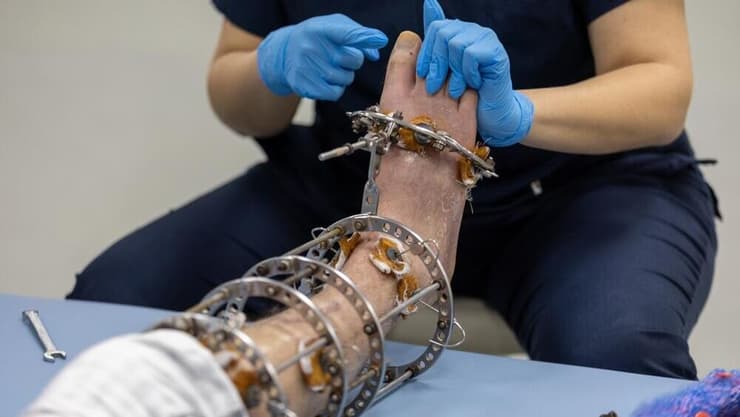 "הייתה לי בעיה בטווחי התנועה, לא הצלחתי ליישר את הרגליים לגמרי". ניתוח הארכת הגפיים הסתבך. אילוסטרציה (צילום: Shutterstock) הארכת גפיים