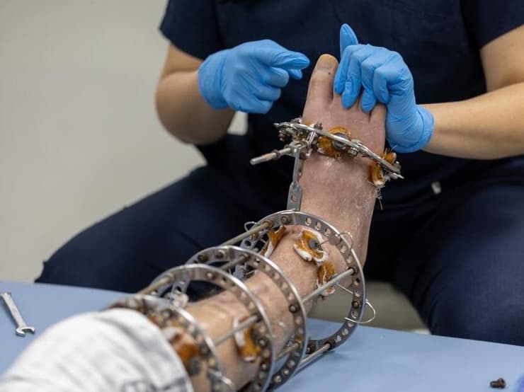 קיבוע העצמות לאחר ניתוח להארכת גפיים. ארכיון (צילום: Shutterstock) הארכת גפיים