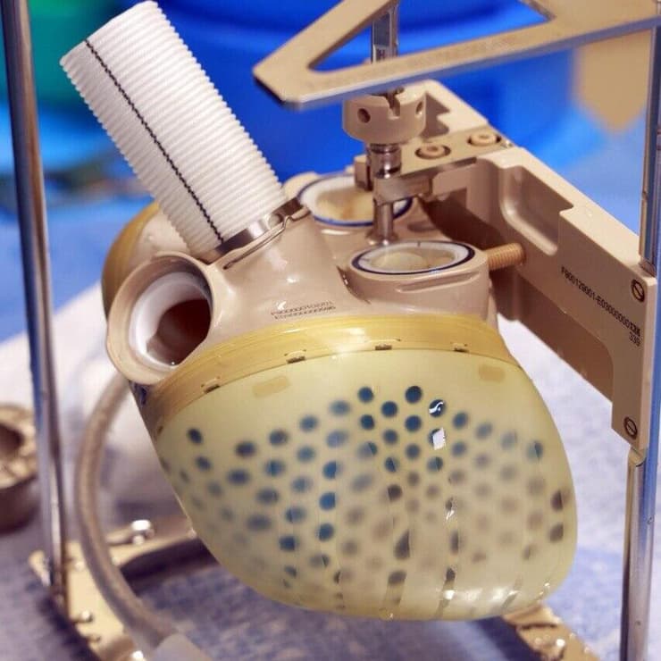 השתלת לב מלאכותי מתקדם Aeson מתוצרת CARMAT במרכז הרפואי שיבא