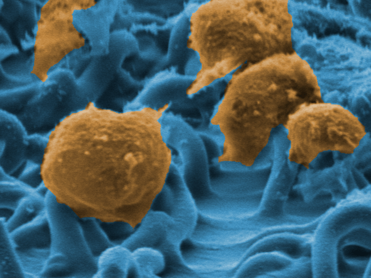צילום מיקרוסקופ אלקטרוני של תאי T שהנדסו החוקרים נגד סרטן 