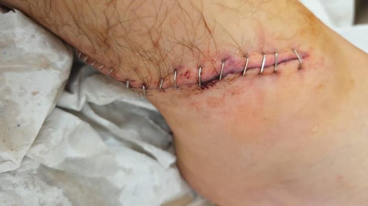 הפציעה של יובל אליאס