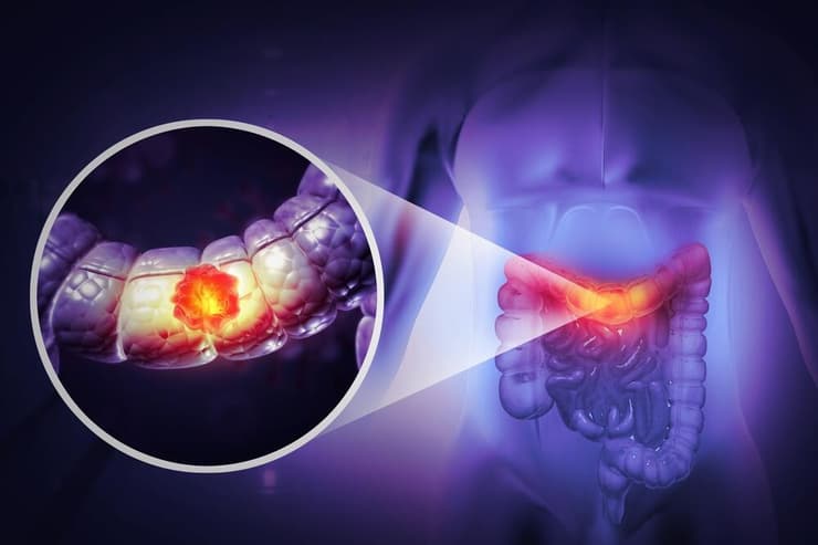 סרטן המעי הגס