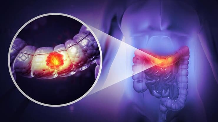 סרטן המעי הגס