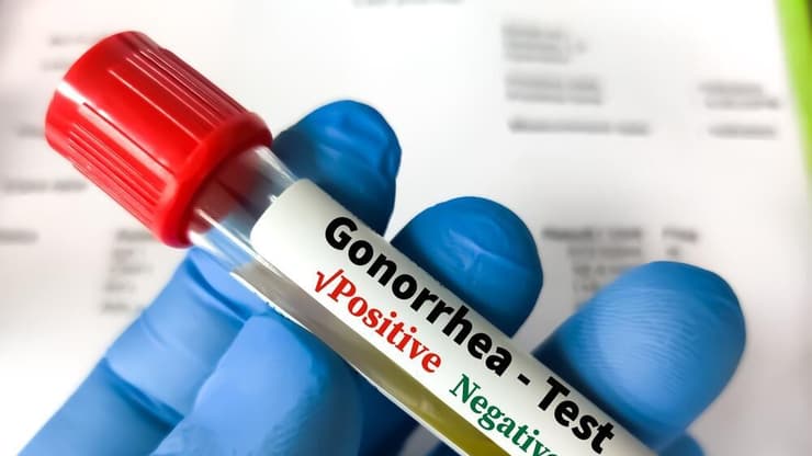 זיבה, מחלות מין