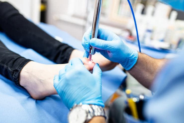 טיפול בפטרת ציפורניים בלייזר