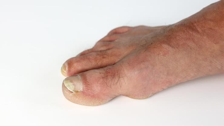 פטרת ציפורניים