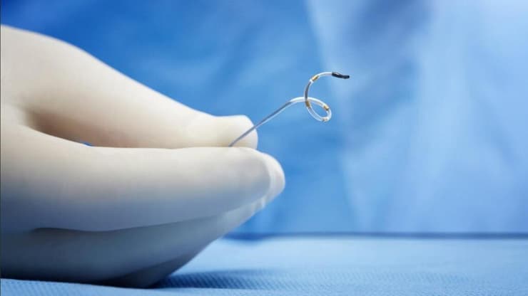 צנתור עורקי הכליות באמצעות צריבת קצות העצבים לטיפול בלחץ דם עמיד