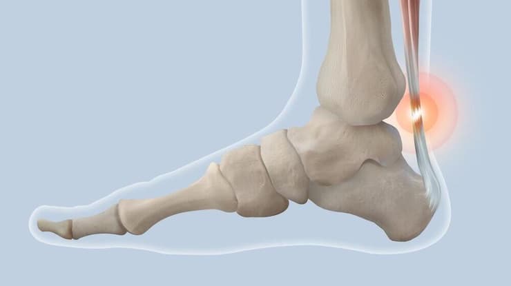 "הגיד בדרך כלל נקרע במקום מאוד ספציפי - בין 6-4 ס"מ מעל האחיזה בעקב" (צילום: shutterstock) קרע בגיד אכילס