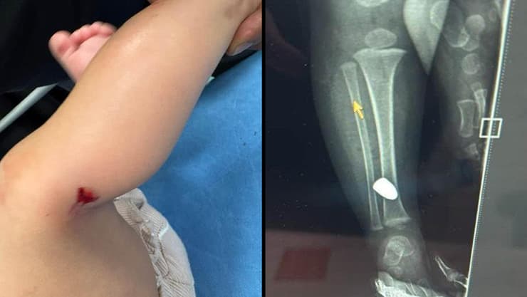 תינוקת בת כתשעה חודשים נפגעה מירי תועה