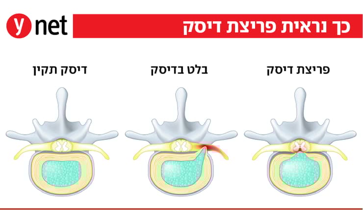 אינפו פריצת דיסק