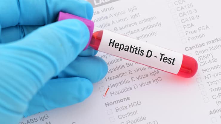 כל אדם שנדבק ב-HDV (הפטיטיס D) נושא בהכרח גם את נגיף HBV (הפטיטיס B) (צילום: Shutterstock) הפטיטיס D