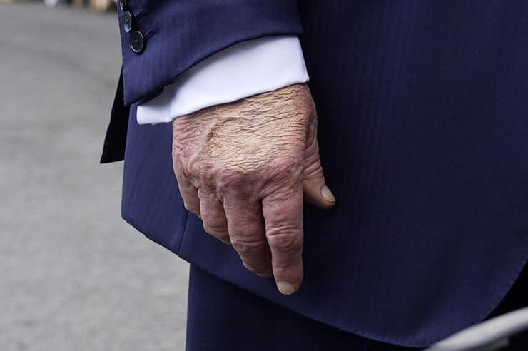 דונלד טראמפ יד חבולה