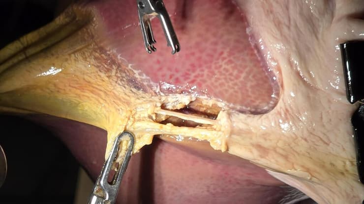 עוד צעד לקראת העתיד. הניתוח בג'ונס הופקינס (צילום: Juo-Tung Chen/Johns Hopkins University/PA) מהלך הניתוח האוטונומי בג'ונס הופקינס