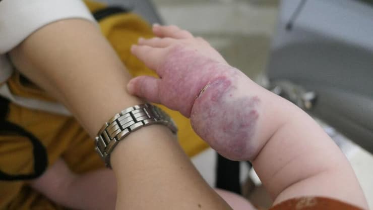 הודיה סבלה ממום בכלי הדם וטופלה בבית החולים הדסה