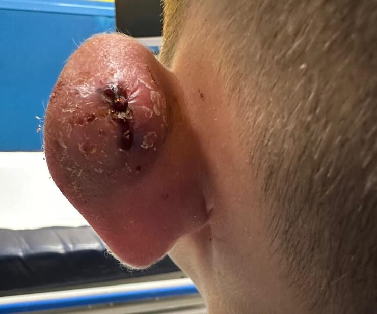 אביתר, זיהום באוזן