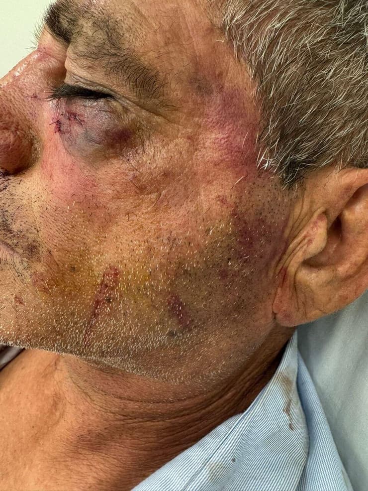 הפגיעה בעינו של גידו (צילום: כוח לעובדים ) נהג אוטובוס שהותקף על ידי נערים בטבריה