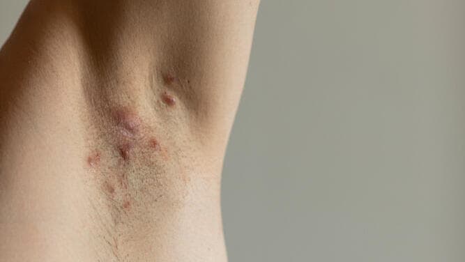 הידרדניטיס סופורטיבה