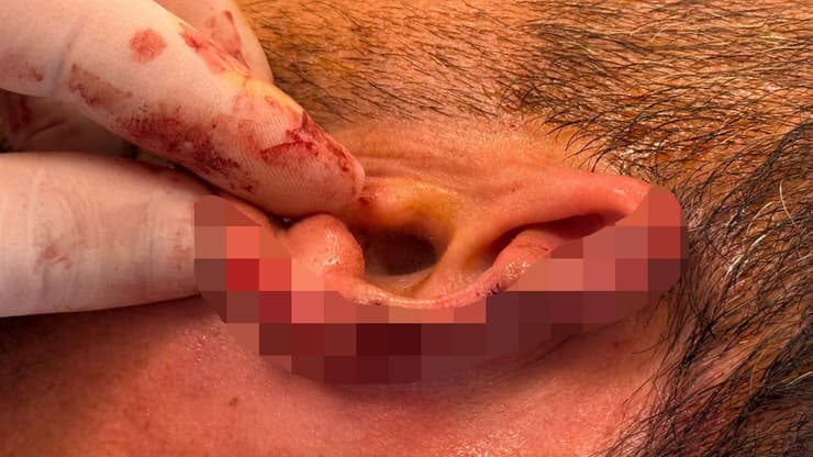 סתיו בן שושן הותקף בזמן חופשה באתונה