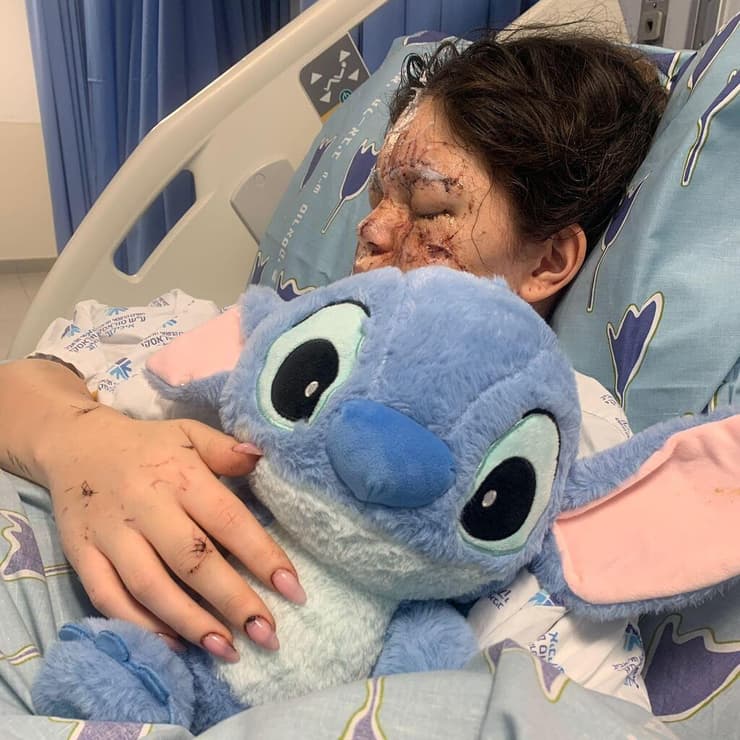 "אני הכי מחכה לטוס לחו"ל, להיות עם חברים בשמש, בים, לחזור להיות עצמאית" (צילום: אלבום פרטי) נועה אמבון נפצעה קשה מטיל איראני בתל אביב