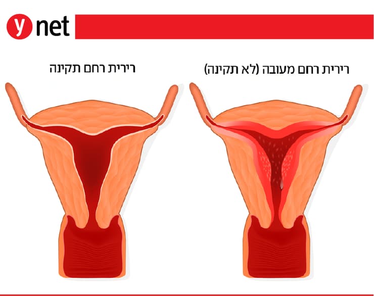 אינפו רירית רחם אינפו רירית רחם