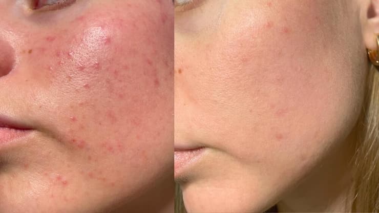 פילינג לפני אחרי טיפוח עור