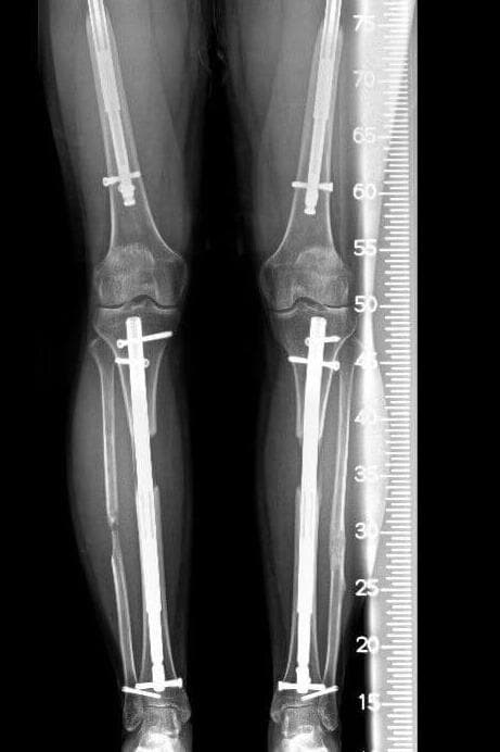 צילום רנטגן של המטופל כשנה לאחר סיום ביצוע ההארכה עם אזורים של חוסר בניית עצם צילום רנטגן של המטופל כשנה לאחר סיום ביצוע ההארכה עם אזורים של חוסר בניית עצם