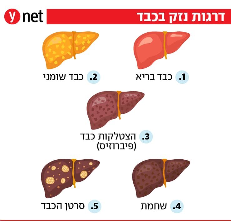 אינפו כבד שומני