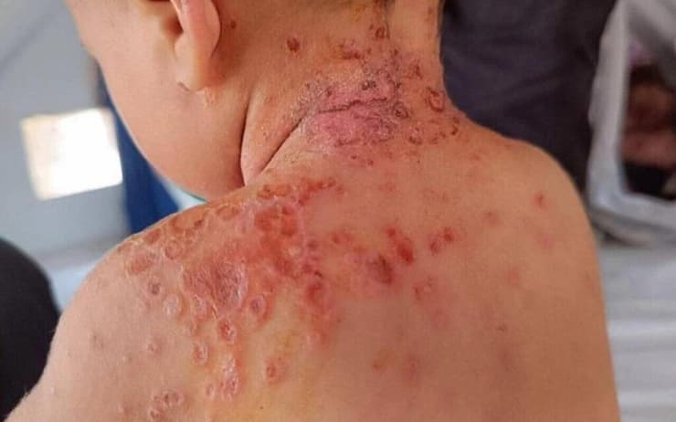 ילד עם מצב קשה של אמפטיגו בבית החולים נאסר