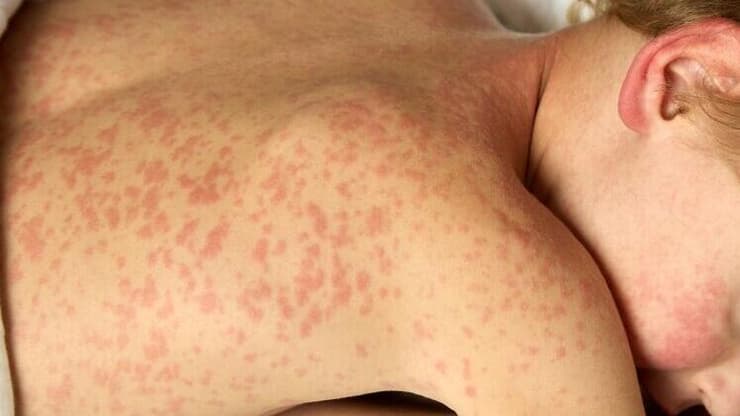 ילד חולה חצבת