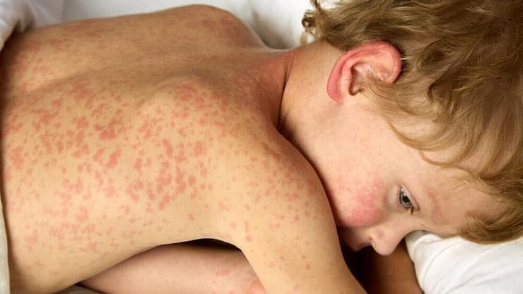 חצבת היא מחלה נגיפית מדבקת ביותר שמתבטאת בחום, הרגשה כללית רעה, נזלת ופריחה ועלולים להיות לה סיבוכים קשים ואף מסכני חיים (צילום: shutterstock) ילד חולה חצבת