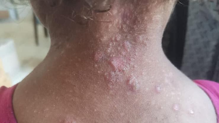 פריחת סקביאס בעורף של ילדה עזתית