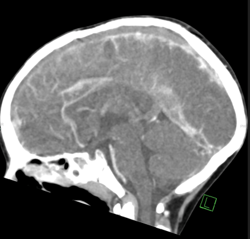 "לצערנו, המצב שלו לא השתפר לאחר הצנתור הראשון". הרופאים נאלצו לחזור על ההליך בשנית (צילום: שערי צדק) שבץ מומחי בצילום הדמיה