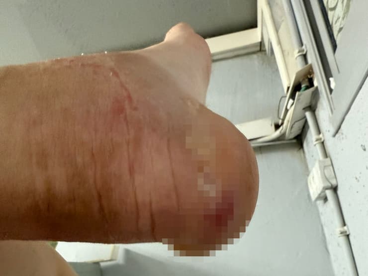 מצבה הרפואי של חיילת המשרתת בבסיס סיירים התדרדר בשל תנאי הגיינה לקויים - כל הרגליים שלה התמלאו בנגעים שנראים כמו אלרגיה