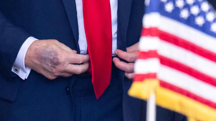 חבורה פצע על כף יד ימין של נשיא ארה"ב טראמפ באירוע בבית הלבן