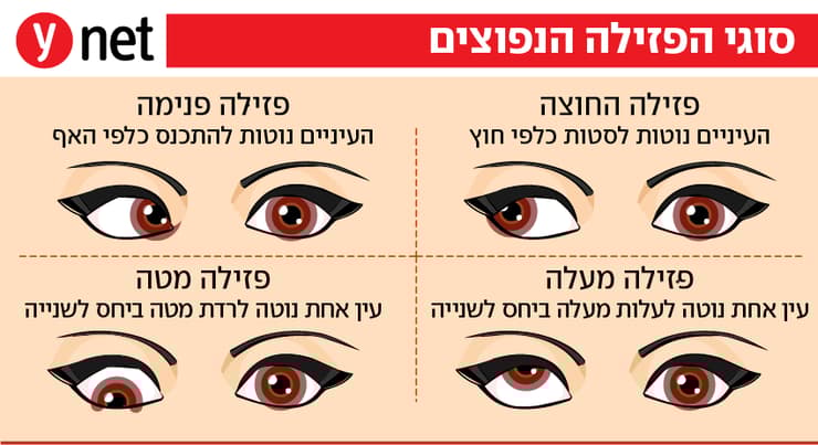 אינפו פזילה אינפו פזילה