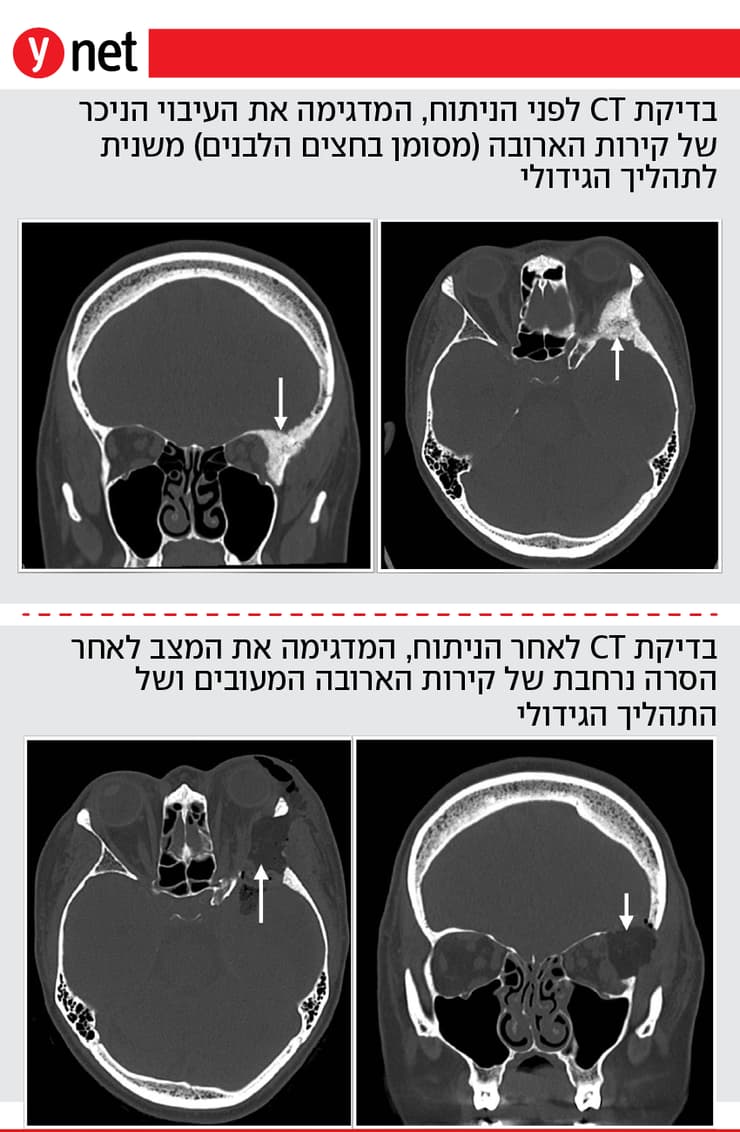 אינפו מתוקן ניתוח ארובת העין איכילוב