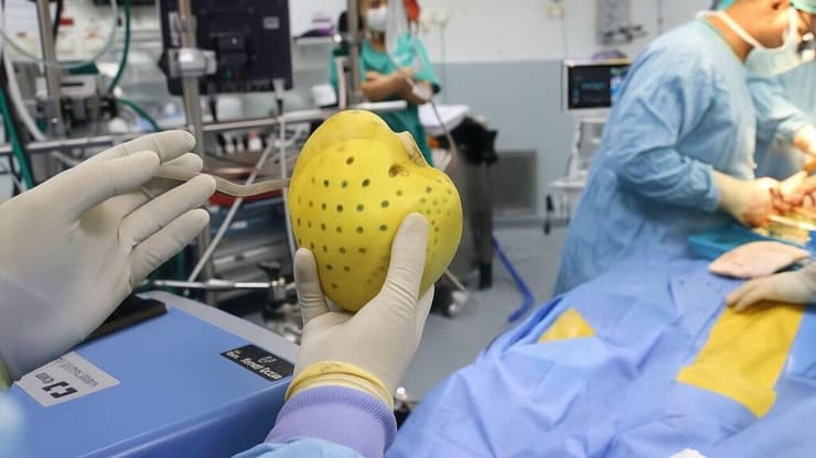 "גשר" עד לפתרון האולטימטיבי: הלב המלאכותי המלא שהושתל לפני כמה חודשים (צילום: יחידת הצילום, שיבא) השתלת לב לאחר לב מלאכותי בבית החולים שיבא