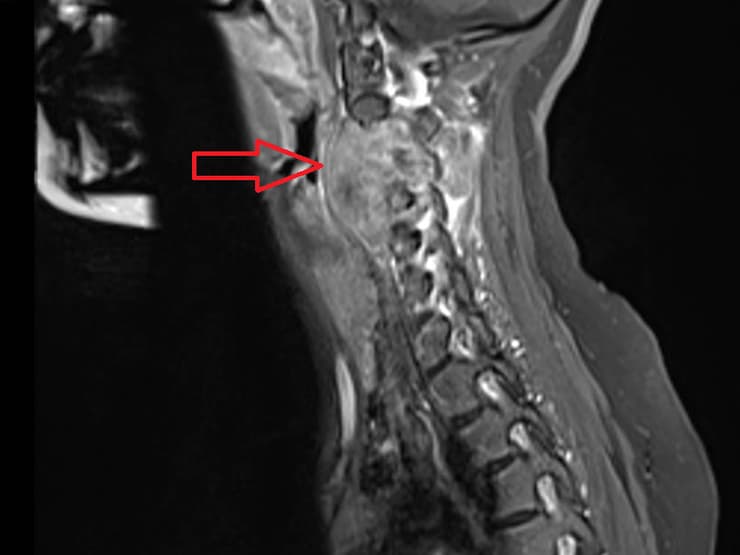 בניתוח הממושך הוסרה החוליה הנגועה בסרטן (צילום הדמיה: באדיבות פרופ' צבי לידר) שני שעיו עברה ניתוח להסרת חוליה נגועה ב סרטן. בצילום CT זה נראית החוליה הנגועה בגידול