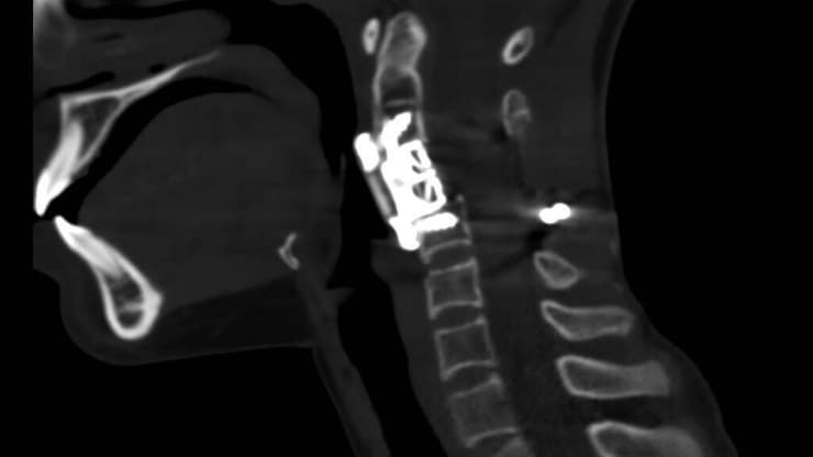 בצילום CT זה נראית החוליה המלאכותית שהושתלה במקום החוליה הנגועה שהוסרה בשלמותה (צילום הדמיה: באדיבות פרופ' צבי לידר) שני שעיו עברה ניתוח להסרת חוליה נגועה בסרטן. בצילום CT זה מודגם מצב לאחר ניתוח שבו הוסרה החוליה הנגועה בשלמותה הצילום מראה את השתלת החוליה המלאכותית