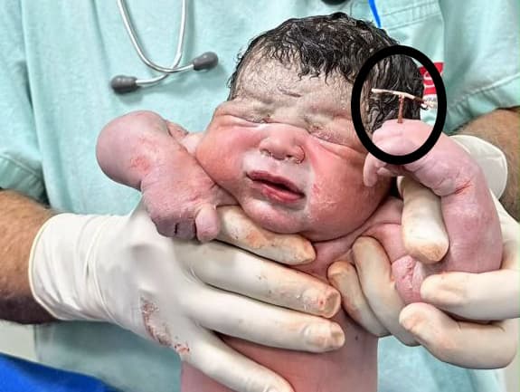 כוכב נולד: התינוק מתאוס גבריאל תועד עם התקן תוך-רחמי (צילום: חשבון האינסטגרם של Natalia Rodrigues) התינוק מתאוס גבריאל תועד עם התקן תוך-רחמי