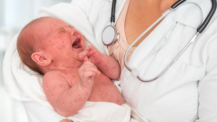 תינוק חולה חצבת